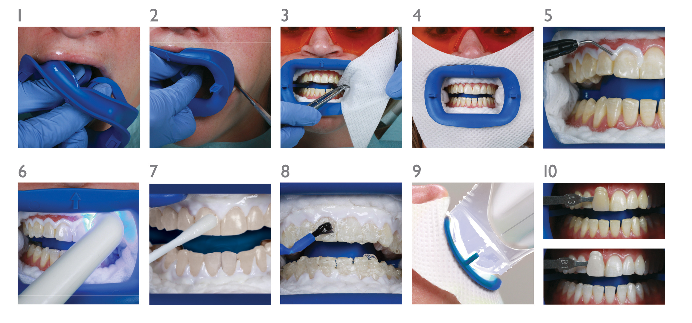 Zoom whitening shade guide - equiiop